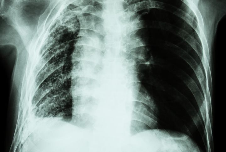 Atlectasie : radio des poumons montrant une atélectasis, ou collapsus d'une partie des poumons