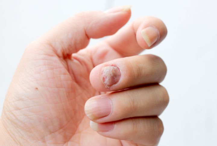 Dermatophytes : image d'une main d'homme. Un des ongles est touché par une mycose. 