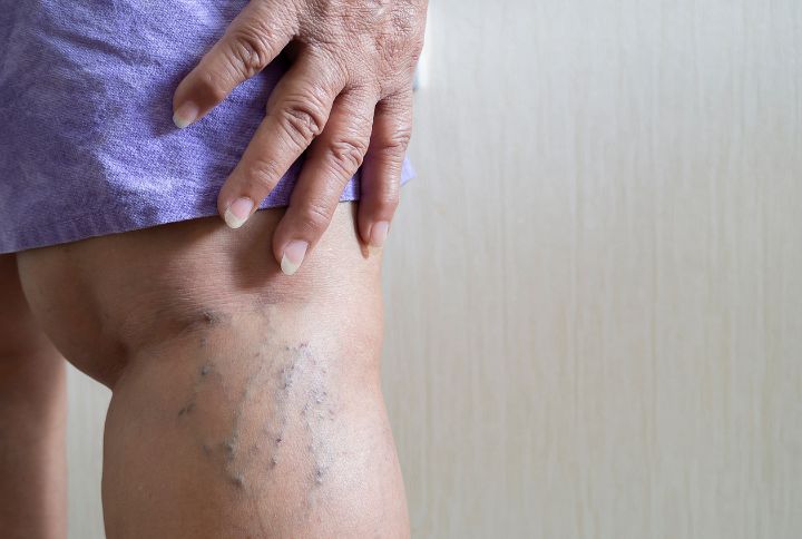 Ectasie : image de varices sur la jambe d'un homme