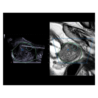 fusion IRM et échographie. Biopsie atteignant la cible