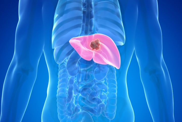 Kyste hepatique : schéma d'un foie humain contenant un kyste hepatique