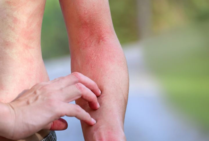 Piqûre de chenille processionnaire