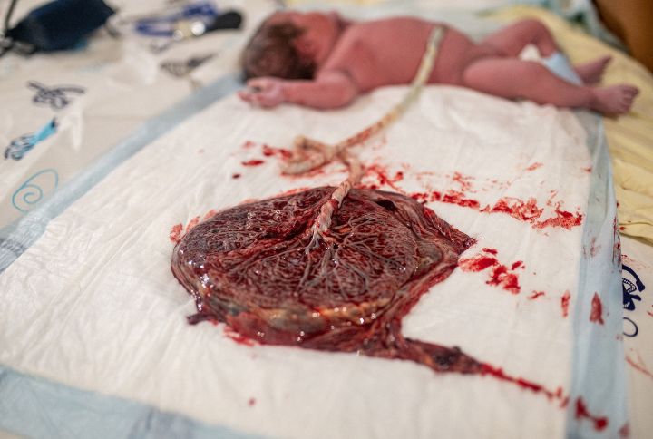 Placenta : image d'un placenta posé sur une table d'accouchement, rattaché à un bébé par un cordon ombilical
