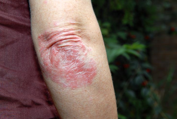 Psoriasis inversé: image du coude d'un homme touché par le psoriasis inverse