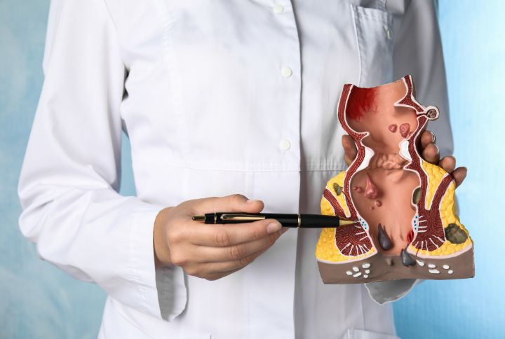 Rectite : image d'un medecin tenant une maquette de rectum