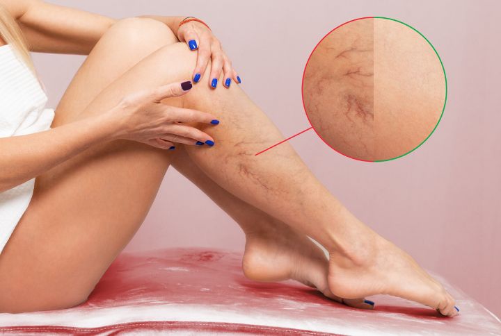 Syndrome de May-Thurner : image des jambes d'une femme assise , présentant des vergetures