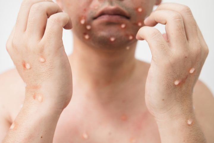 Variole du singe ou mPox : image d'un homme touché par la varole du singe, présentant une éruption cutanée sous la forme de petite tâches