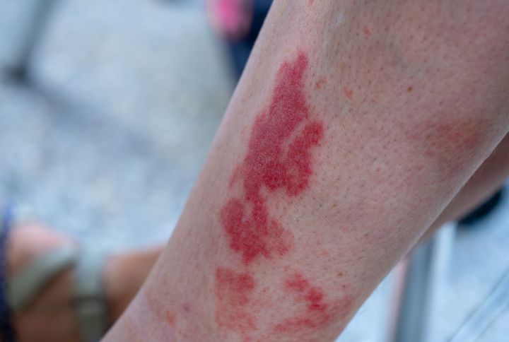 Vascularite image d'une jambe recouvertes d'éruptions cutanées, conséquence d'une vascularite