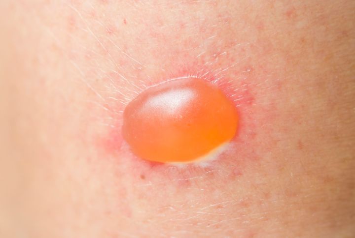 Pemphigus vulgaire : image d'une cloque sur la peau.