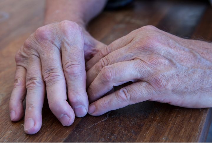 Rhumatisme psoriasique : mains atteintes de rhumatisme. Articulations des doigts déformées (dactylite).