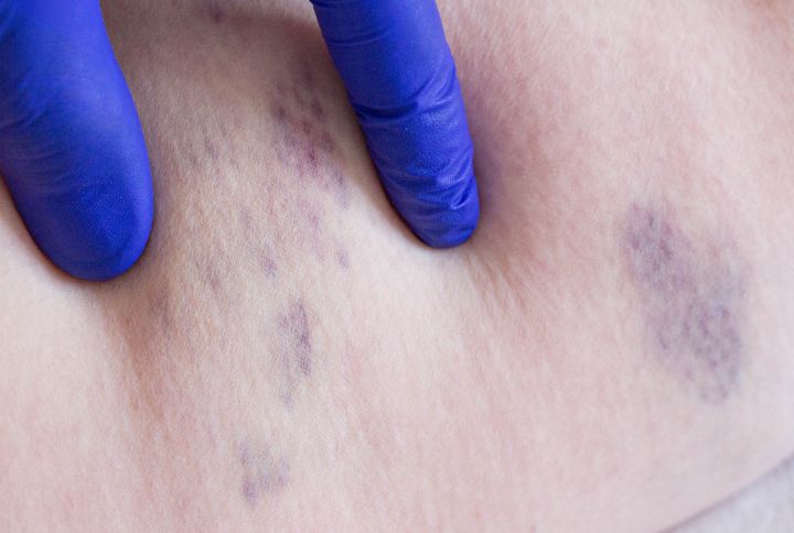 Thrombose veineuse profonde. Image de coloration sur la peau : taches violettes.