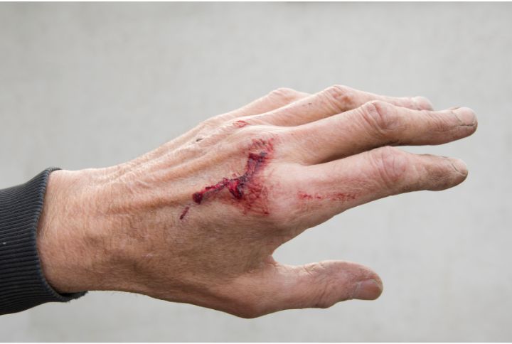 Blessures : les sept traumatismes les plus fréquents. Image d'une main avec une plaie fermée avec présence de sang séché et ecchymoses.
