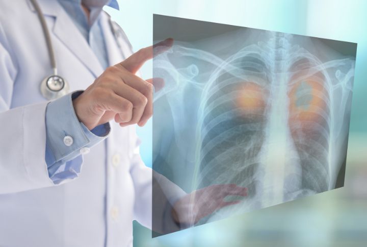 Cancer du poumon : peut-on guérir d'un cancer à petite cellule CPPC ? Image d'un médecin en blouse blanche pointant une radiographie des poumons.