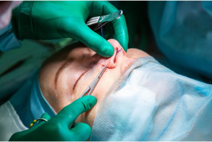 Septoplastie : quelle différence avec la rhinoseptoplastie ? Image d'une opération du nez. Une ou un chirurgien est en train de recoudre un nez.
