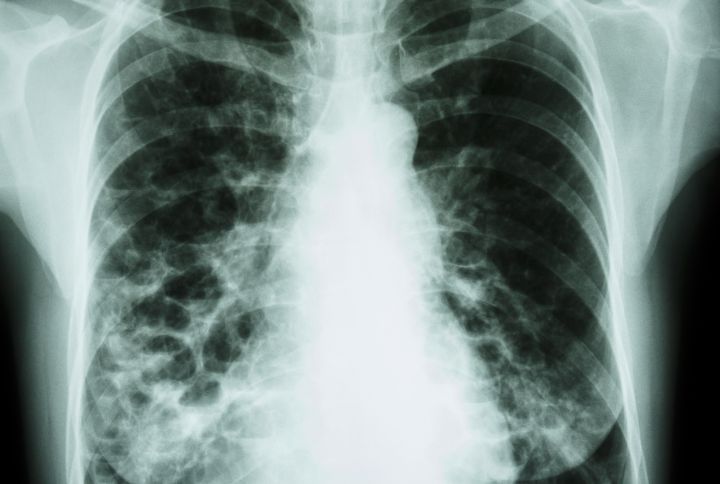 Dilatation des bronches (DDB) ou bronchiectasie ou bronchectasie. Radiographie des poumons montrant bulles et kystes en lien avec une infection chronique.