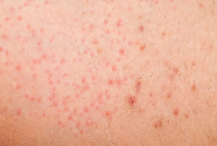 Folliculite : gros plan sur une peau avec de petits boutons rouges.
