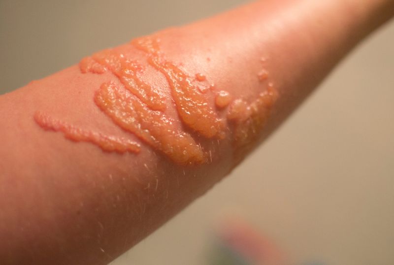 Traces de piqûre de méduse sur la peau d'un bras : petites lésions rouges sous forme de vésicules qui contiennent un liquide (comme des cloques après une brûlure).