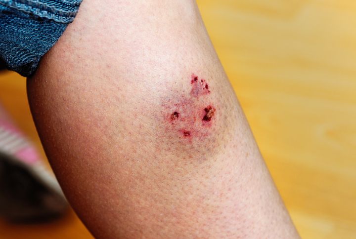 Morsure de chien, comment réagir ? Quatre traces de dents de chien sur un mollet avec ecchymose.