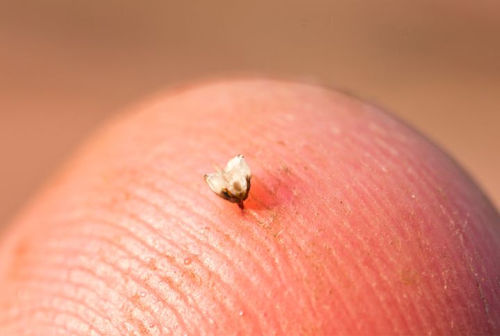 piqûre d'abeille : dard enfoncé dans la peau, l'abeille a arraché le bas de son corps en s'échappant.