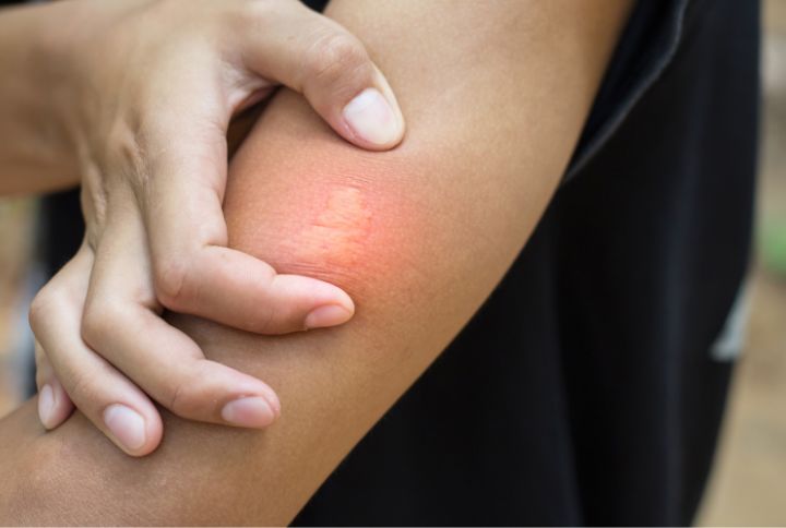 piqûre d'abeille : rougeur et gonflement typique sur le site de la piqûre.