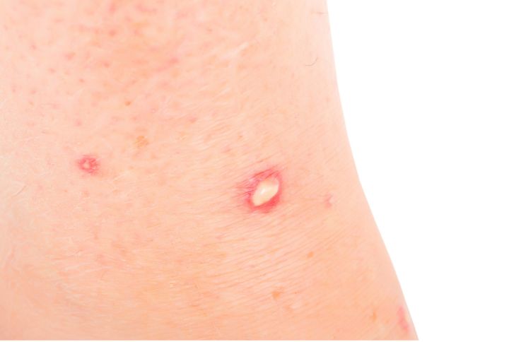 Piqûre de fourmi rouge, la reconnaître et la soigner. Piqûre de fourmi sur la peau : présence de pustule blanche.