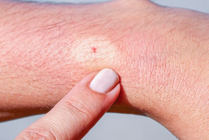 Piqûre d'hymenoptère. Ici une abeiile. Point rouge de la piqûre entouré d'un cercle blanc.