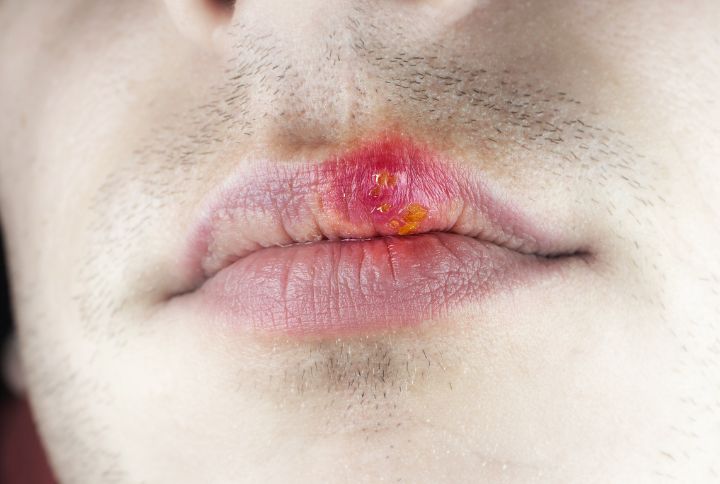 Herpès : comment le soigner. Image d'un bouton de fièvre sur la lèvre supérieure.