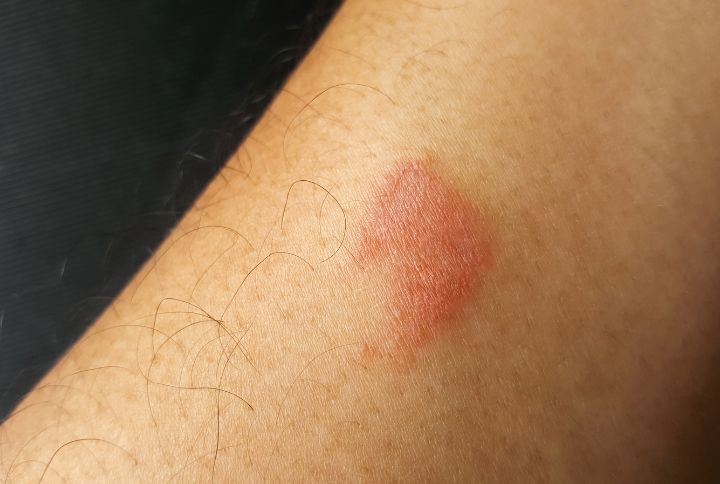 Comment réagir face à une morsure de scolopendre ? Image d'une morsure de scolopendre, petite plaque rouge légèrement gonflée.