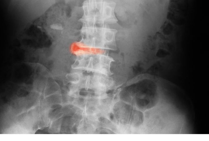 Spondylarthrite ankylosante : radiologie montrant une atteinte de la colonne vertébrale entre deux vertèbres.