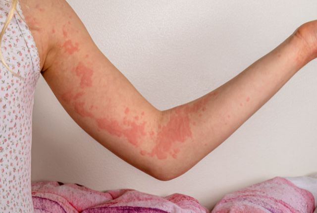 Urticaire : journée mondiale le 1er octobre 2024. Jeune fille avec le bras couvert de plaques rouges.